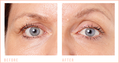 Before and After Eye Revive 1