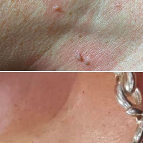 before and after skin tag 3